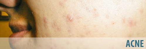 nodular acne treatment homeopathic